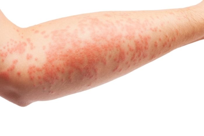 Santé ► Eczéma : quatre réflexes pour profiter du soleil